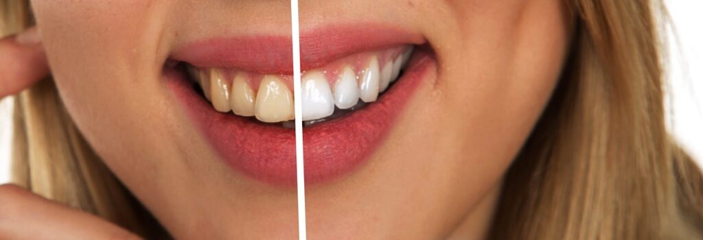 In-Office Teeth Whitening vs. Over-the-Counter Options
